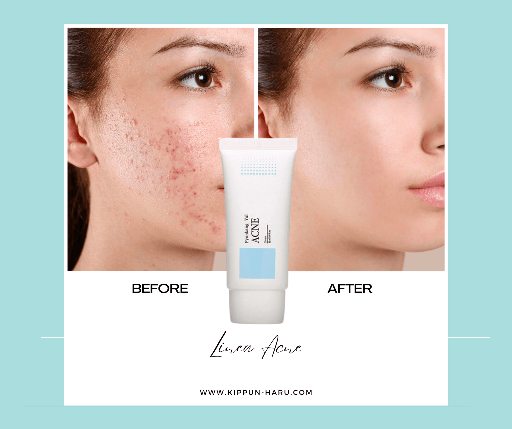 Gli effetti anti-acne della linea ACNE di Pyunkang Yul