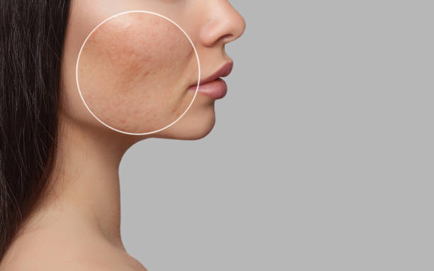 Skincare Coreana per Pelle Acneica: i migliori prodotti contro l'acne