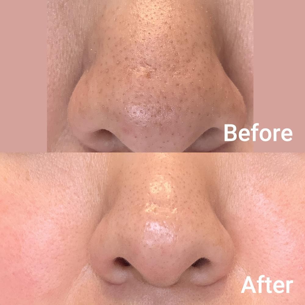 Medicube Zero Pore Pad 2.0, 155g, 70 dischetti