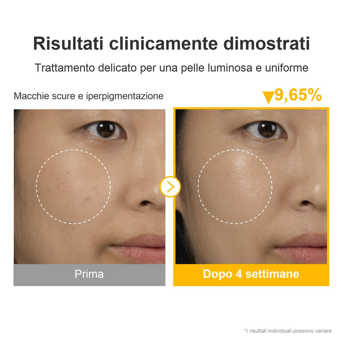 Risultati prima e dopo quattro settimane con Numbuzin No.5+ Glutathione Vitamin Concentrated Serum
