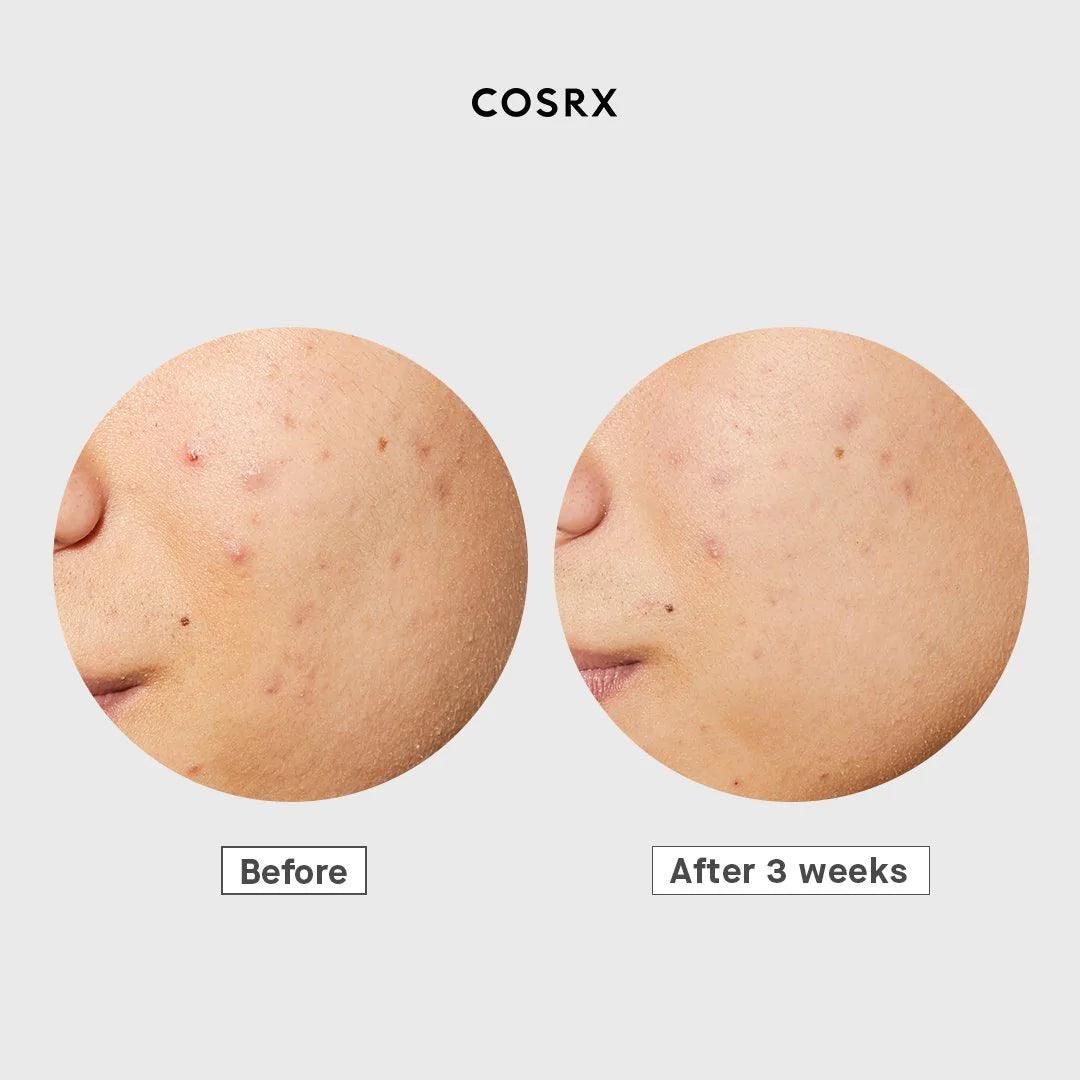 COSRX AC Collection Ultimate Spot Cream, 30g